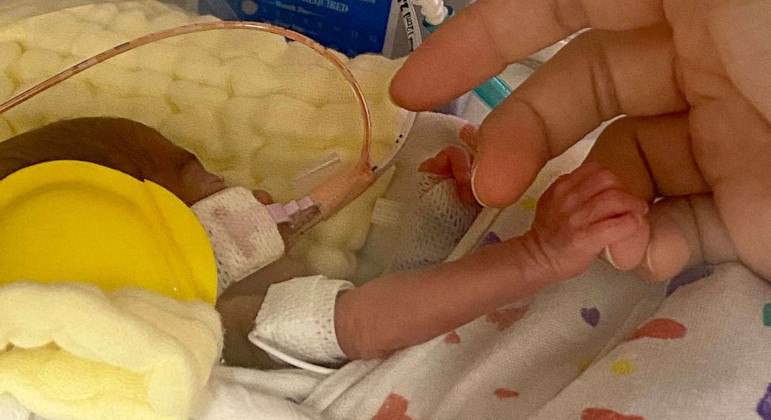 Jari no hospital quando nasceu com 326 gramas - Foto: arquivo pessoal / AMBER HIGGINS