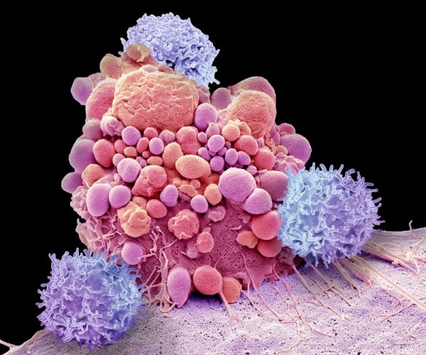 A terapia com células T CAR modifica as células T — mostradas aqui atacando uma célula cancerosa do cérebro — para reconhecer proteínas específicas - Foto: Steve Gschmeissner/Science Photo Library