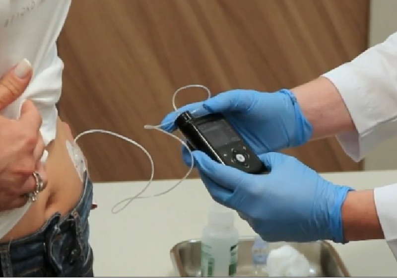 Uma brasileira de Curitiba recebeu o 1º implante de pâncreas artificial do país - Foto: reprodução / TV Globo / JN