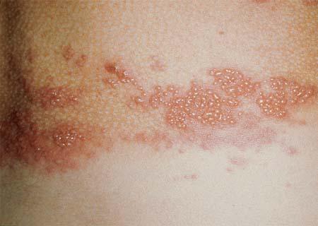 Bolhas e vermelhidão provocadas pela herpes-zoster na pele - Foto: WikiMedicaCommons / GNU