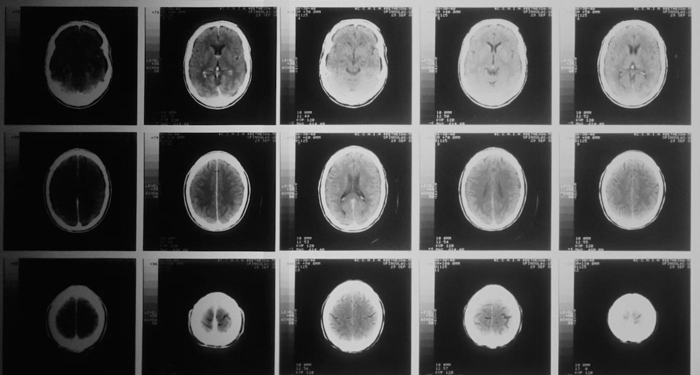 O novo remédio experimental contra Alzheimer passou na fase 3 de testes - Foto: GNN