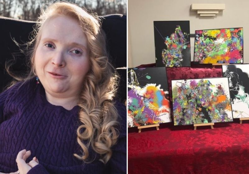 Embora a artista Emily viva com uma condição que a silenciou, ela ainda é capaz de se comunicar e se expressar com os olhos. Fotos: Redes Sociais