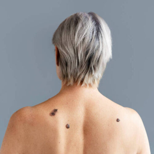 Melanoma é um câncer de pele agressivo em que as células podem se espalhar pelo sangue - Foto: Pixabay