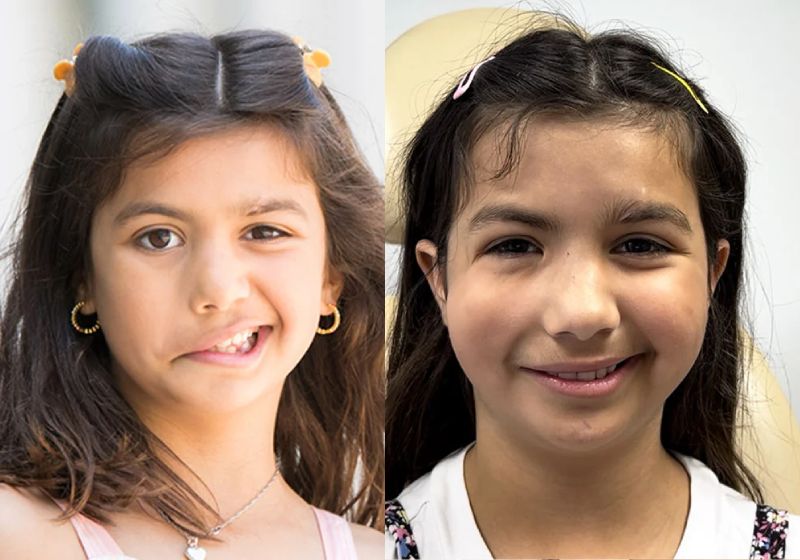 Nicole teve paralisia facial e uma cirurgia pioneira devolveu a autoestima à menina de 11 anos - Fotos: Cleveland Clinic