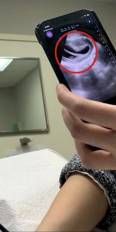 O útero em forma de coração na radiografia - Foto:: SWNS