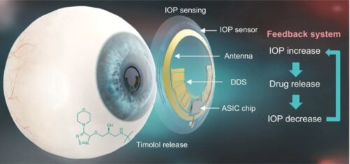 Ilustração esquemática da lente de contato teranóstica para tratamento de glaucoma. - Foto: Postech 