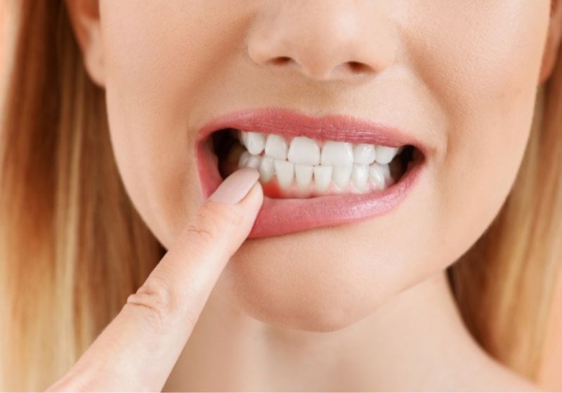 A pesquisa da Universidade de Rice mostrou que cuidar dos dentes pode diminuir crises de artrite. Foto: Reprodução/Idealdonto.