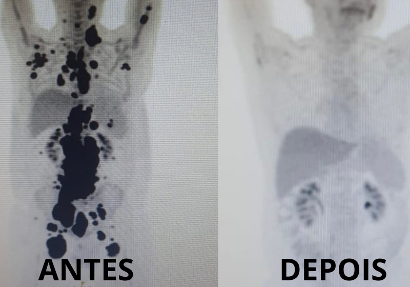 As imagens mostram a remissão do câncer um mês após a terapia revolucionária brasileira. Foto: Reprodução/Arquivo pessoal.