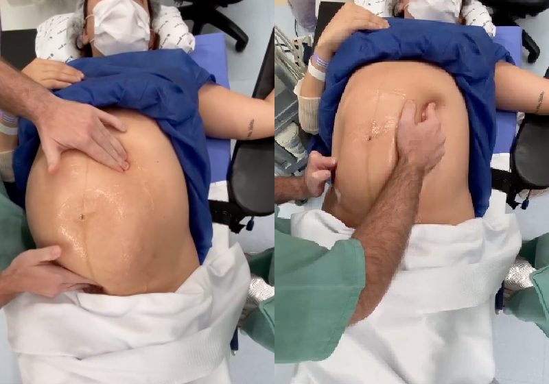 Com muito cuidado e técnica, o médico brasileiro vai virando o bebê na barriga da mãe até ele se encaixar para o parto normal - Fotos: reprodução / Youtube