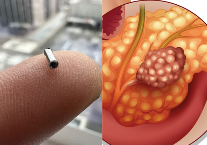 O implante, apesar de ter tamanho menor do que um grão de arroz, apresentou resultados poderosíssimos no combate ao câncer de pâncreas. Foto: Reprodução/Revista Saúde e Houston Methodist.