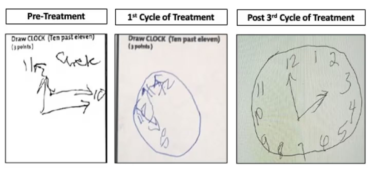 A mulher que acordou após 20 anos desenhou esses relógios, que mostram sua evolução cognitiva - Fotos: Sander Markx