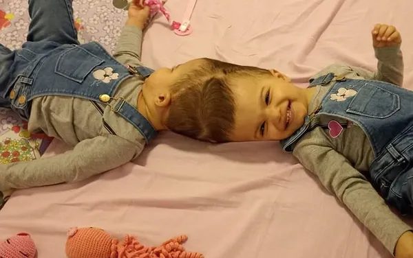 As gêmeas Allana e Mariah foram operadas no Hospital das Clínicas de Ribeirão Preto, SP — Foto: Divulgação HC Ribeirão