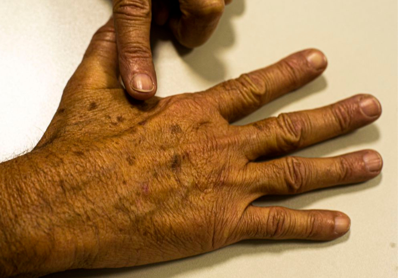 O câncer de pele comum será tratado no SUS com o auxílio da tecnologia desenvolvida por pesquisadores da USP. -Foto: Reprodução / Marcello Casal Jr / Agência Brasil