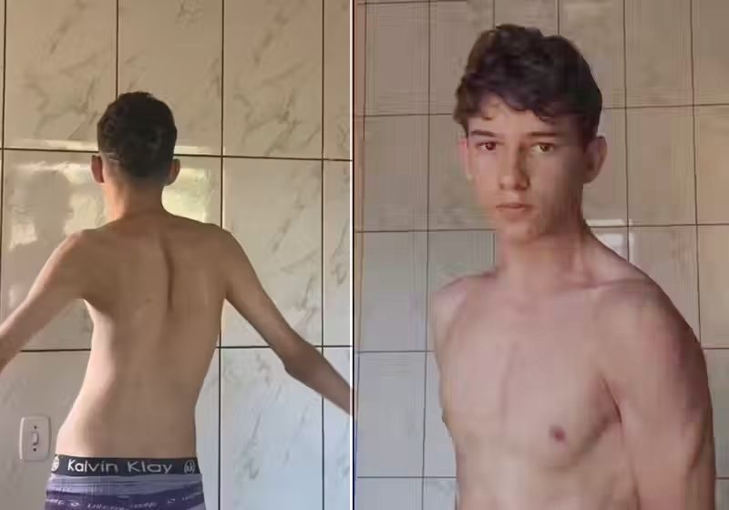 A cirurgia do jovem, que tinha escoliose, foi um sucesso e André ganhou uma nova vida e autoestima. - Foto: Reprodução/Instagram/@andre_firee.