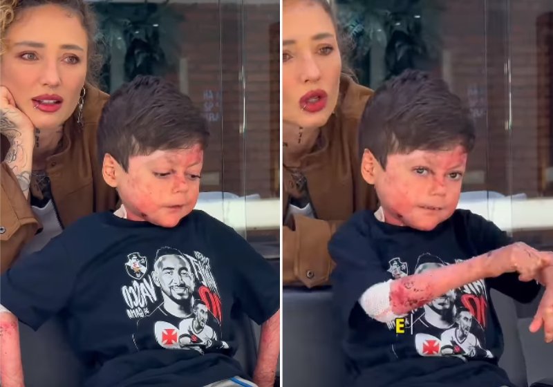 Gui conta do jeito dele o que é ter epidermólise bolhosa e o vídeo viraliza - Foto: reprodução redes sociais