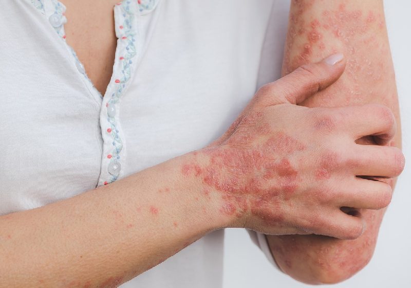 Os curativos à base de Aloe Vera para tratar psoríase foram desenvolvidos na Unesp - Foto: Eszter Miller / Pixabay