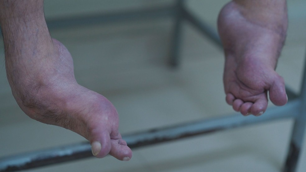 Os pés de Nelson eram assim no início do tratamento... Foto: Reprodução/TV Globo.