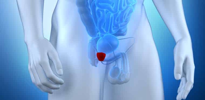 O câncer de próstata é uma doença silenciosa. Homens devem fazer o exame preventivo a partir dos 40 anos, se tiverem casos na família, ou 45 anos se não tiverem. - Foto: reprodução / sanarmed