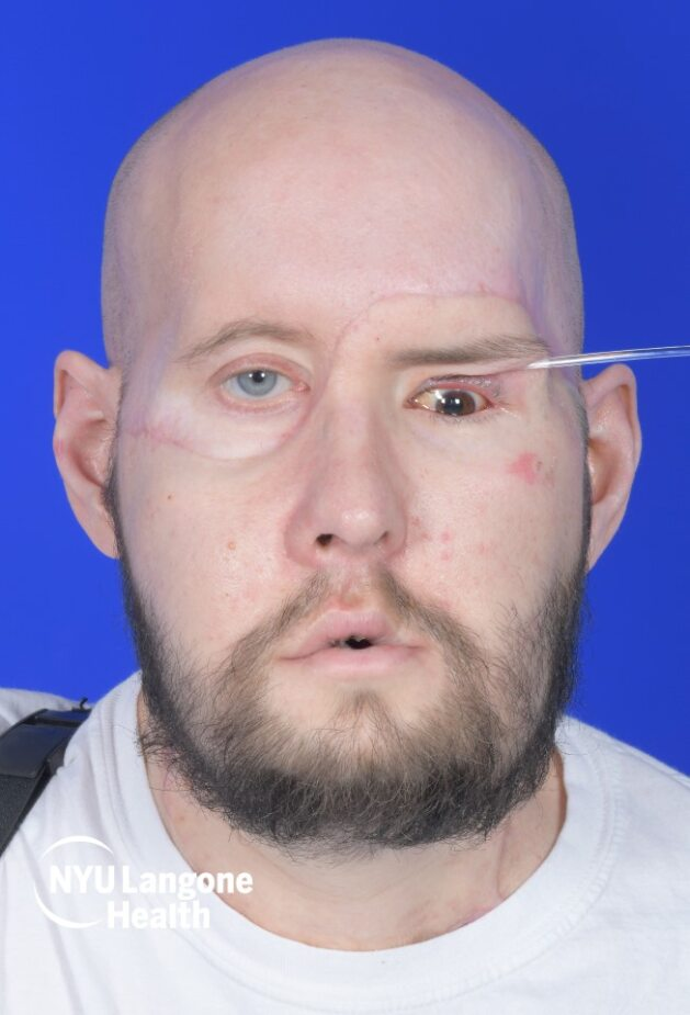 Aaron já se recupera bem e o olho teve boa aceitação no corpo do paciente. Foto: Reprodução/NYU Langone.