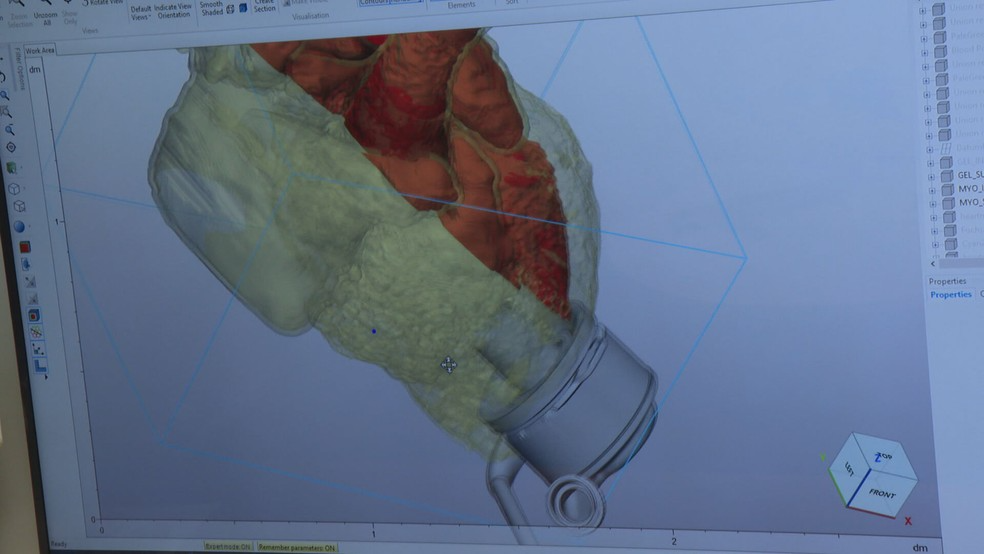 O ventrículo artificial foi estudo com calma até que os profissionais tivessem a certeza de onde instalar o objeto. Foto: TV Globo.