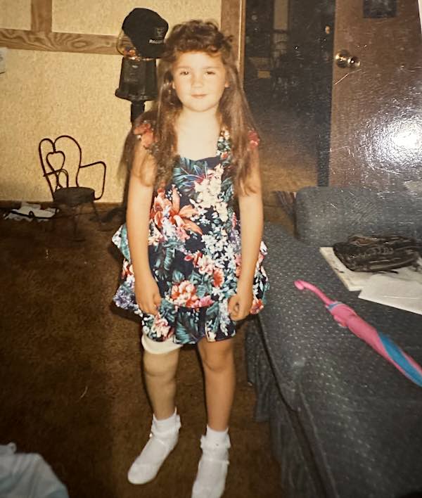 Krystal foi diagnosticada com Síndrome da Banda Amniótica e para fazer o tratamento tinha que ir no hospital que ficava longe de casa. - Foto: reprodução/Arquivo Pessoal 