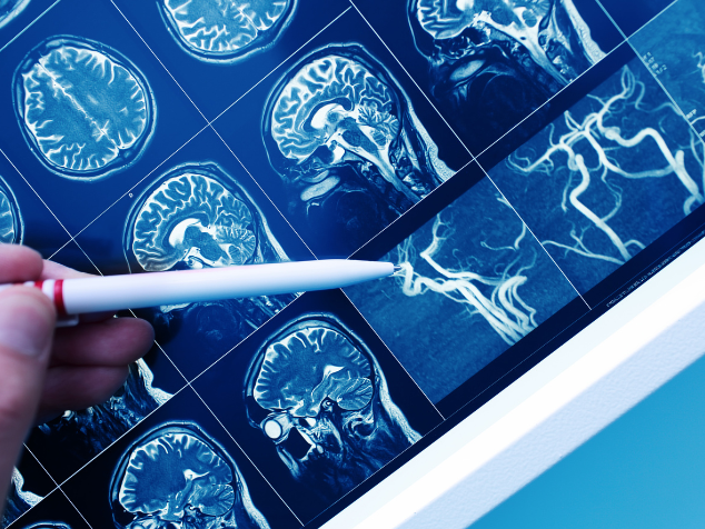 Método acessível pode revolucionar tratamento para mais de 55 milhões de afetados. - Foto: reprodução/Canva Pro 