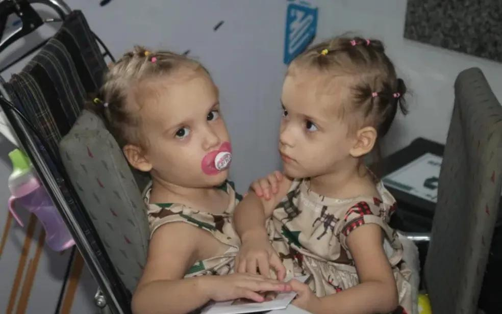  As gêmeas siamesas Valentina e Heloá Prado tinham 3 anos quando fizeram a cirurgia. - Foto: Divulgação/Zacharias Calil