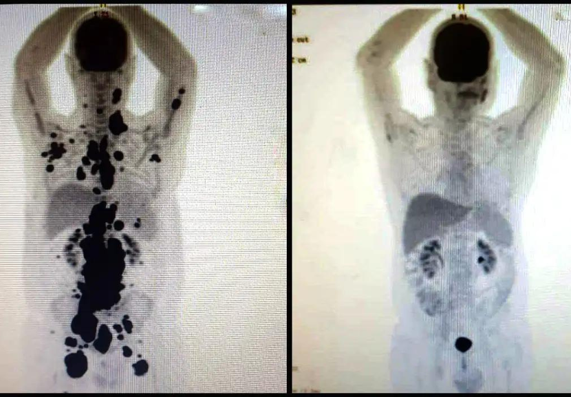 Antes e depois de paciente que recebeu a terapia CAR-T. - Foto: reprodução/arquivo pessoal 