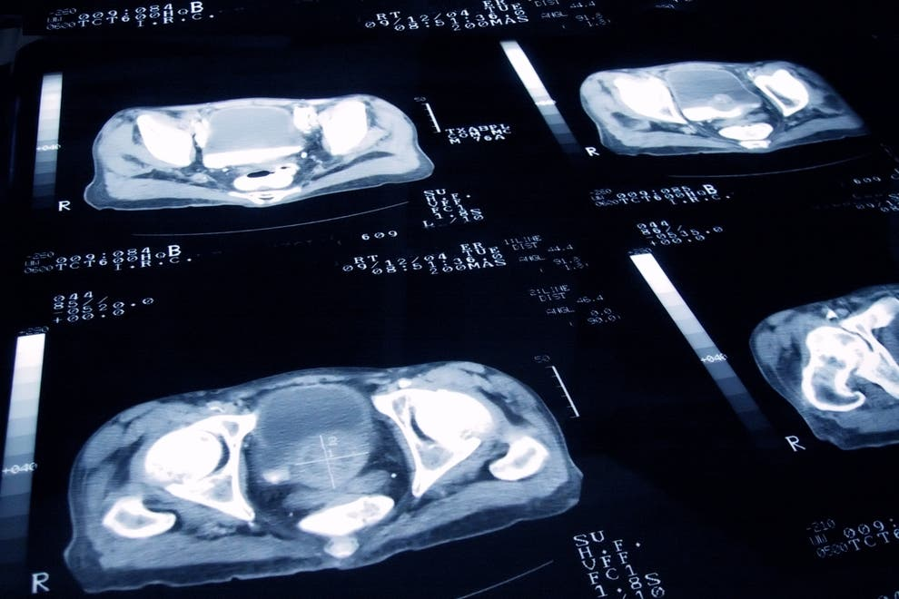 Depois de analisar dados de 159 pacientes, a IA avançou no tratamento contra o câncer de próstata. Foto: Freepik.