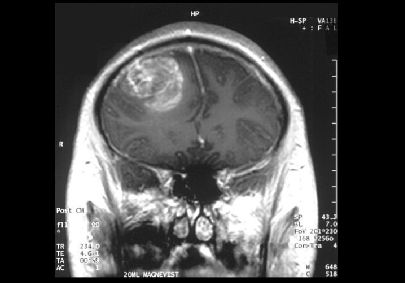Com a terapia CART-T contra câncer no cérebro, um dos pacientes teve uma diminuição de 60,7% no seu tumor e uma mulher teve regressão quase completa do tumor em apenas cinco dias após uma única perfusão. - Foto: MRI of a glioblastoma – CC 2.5. Christaras A