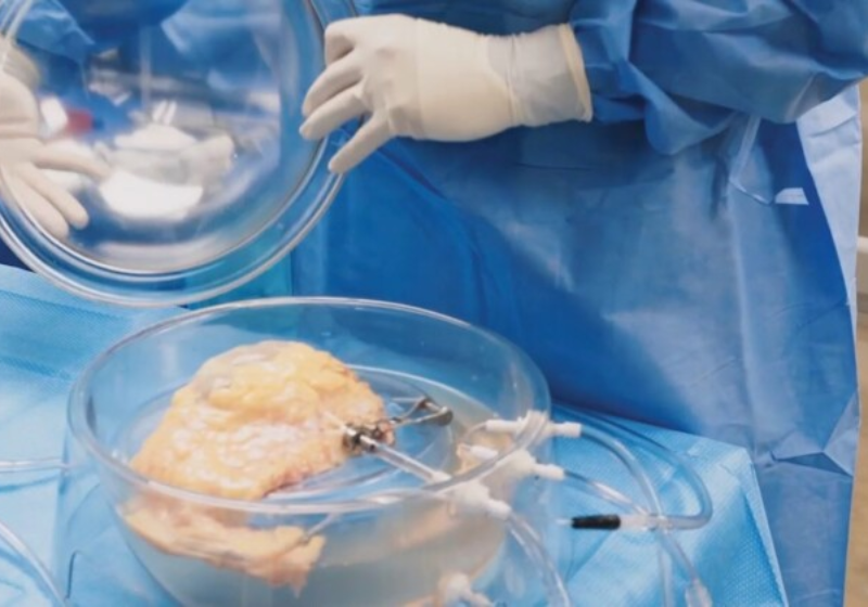 A nova técnica feita nos Estados Unidos "revive" órgãos que seriam descartados e, com ela, pelo menos 10 transplantes de rim já deram certo. - Foto: 34 Lives