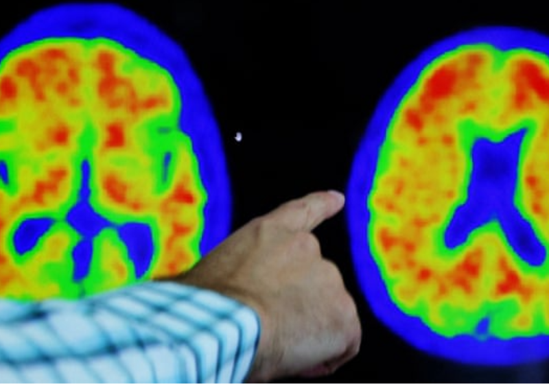 O remédio contra Alzheimer aprovado por consultores da FDA conseguiu retardar o declínio cognitivo em 29% das pessoas com acumulação leve ou moderada da proteína beta-amiloide. - Foto: Brian Snyder (Reuters).