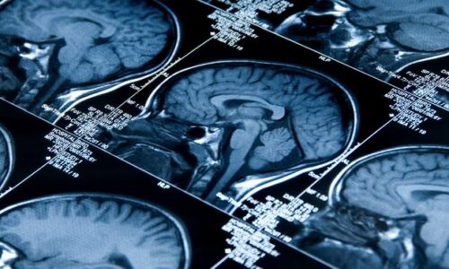 O estudo que detecta demência 9 anos antes foi feito por pesquisadores do Centro de Neurologia Preventiva da Universidade de Queen Mary e da Universidade de Londres, ambas no Reino Unido. - Foto: Haydenbird/Getty Images