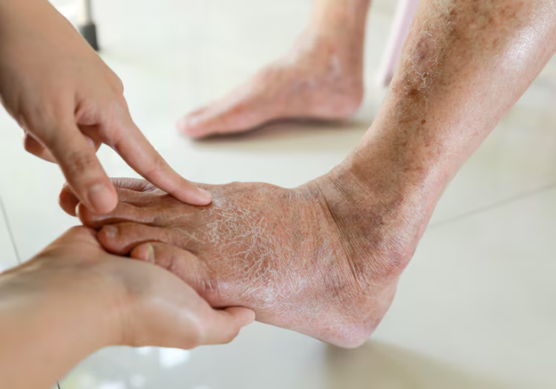 O gel de gengibre-amargo foi testado clinicamente e conseguiu curar feridas e reduzir amputações. Foto: Satjawat/Adobe Stock.