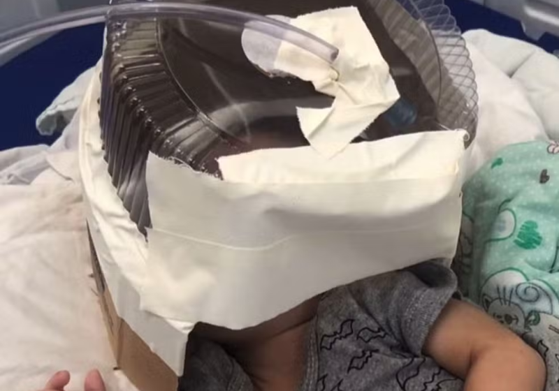 A médica usou uma embalagem de bolo e improvisou uma máscara de oxigênio para bebê em estado grave. - Foto: reprodução