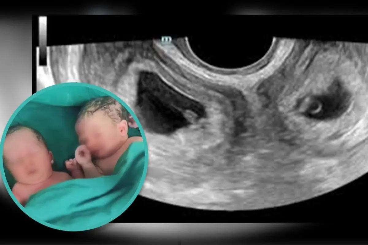 A mulher teve gêmeos em úteros diferentes. Os pequenos nasceram saudáveis e tiveram alta depois de 4 dias. - Foto: Xi'an Hospital