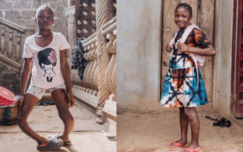 Com as pernas totalmente arqueadas, Fudia que é da África, fez um tratamento inovador. A cirurgia a fez ficar mais alta e sem dor. - Foto: Mercy Ships / SWNS