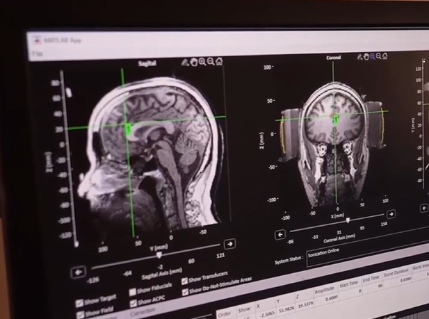 O cérebro do paciente é mapeado previamente para que as ondas sejam direcionadas corretamente. - Foto: WNDU