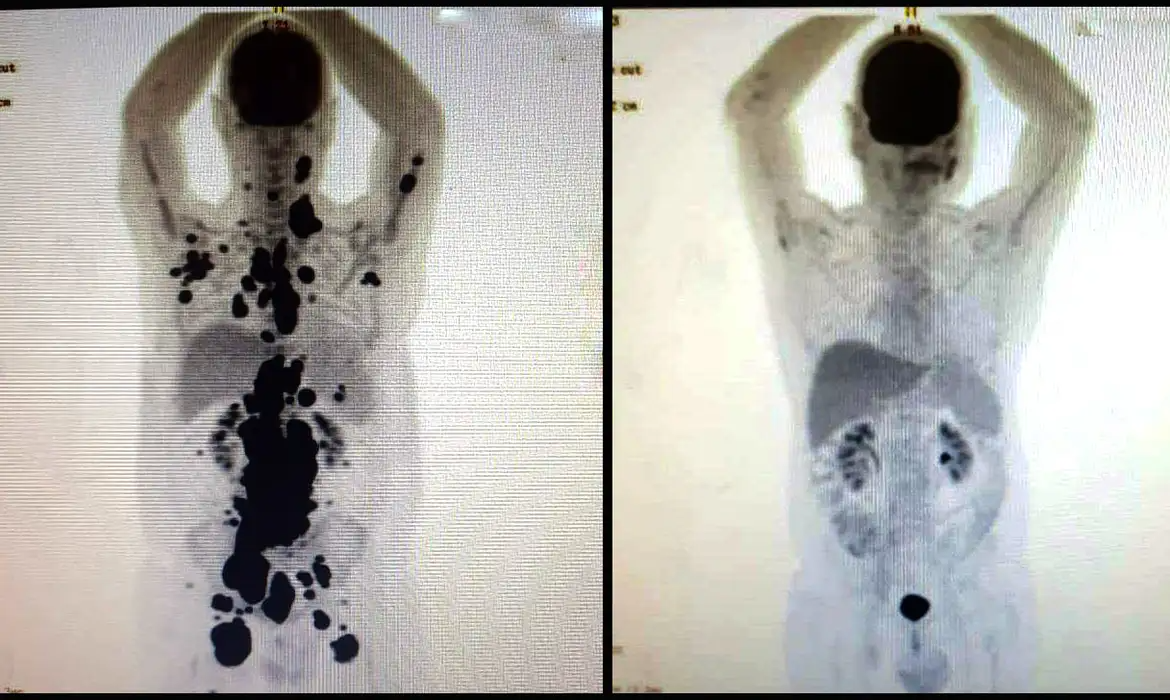 Na foto, um paciente antes e depois de ter sido submetido ao tratamento CAR-T Cell. - Foto: Arquivo pessoal
