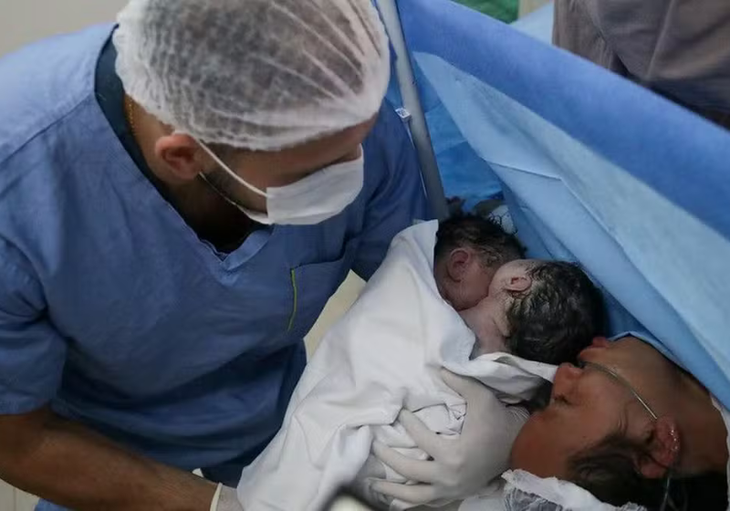 As gêmeas siamesas de Manaus vão passar por exames para saber como será possível fazer a separação. - Foto: Secom Amazonas