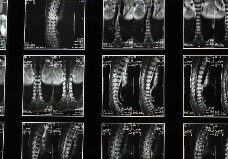 Os cientistas da Universidade de Keio, no Japão, usaram células especiais para recuperar pacientes com lesão na medula espinhal. - Foto: Reprodução/Techspot