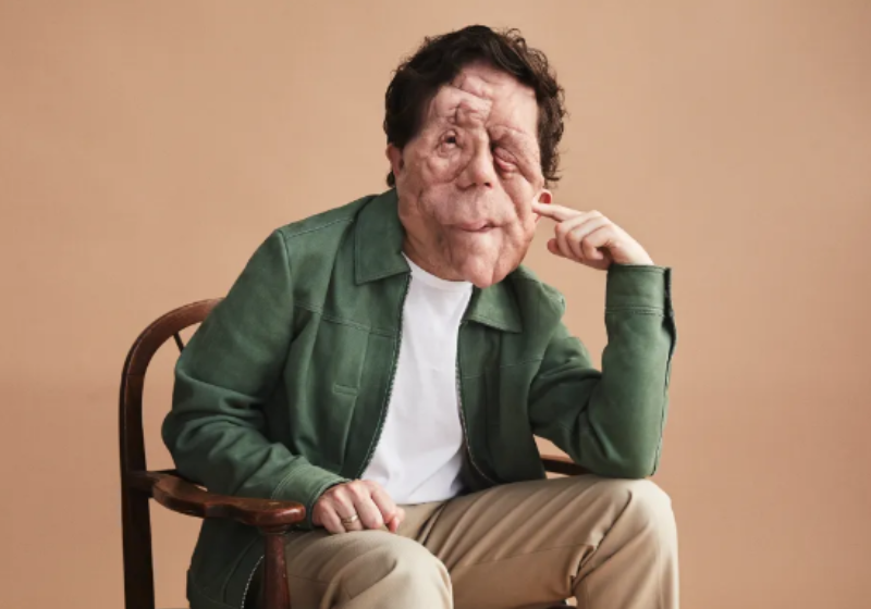 O Homem Elefante, clássico dos anos 80, terá remake no cinema com Adam Pearson O remake de O Homem Elefante vai ter Adam Pearson vivendo Joseph Merrick. - Foto: Variety