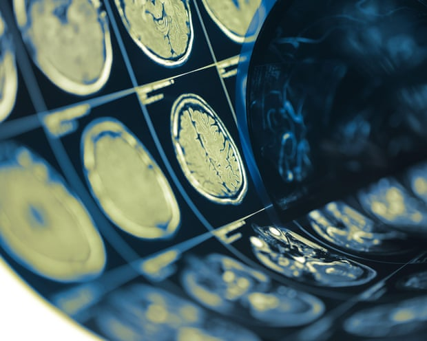 O estudo envolveu mais de 700 pacientes em 24 países. - Foto: Yuriy Klochan/Alamy