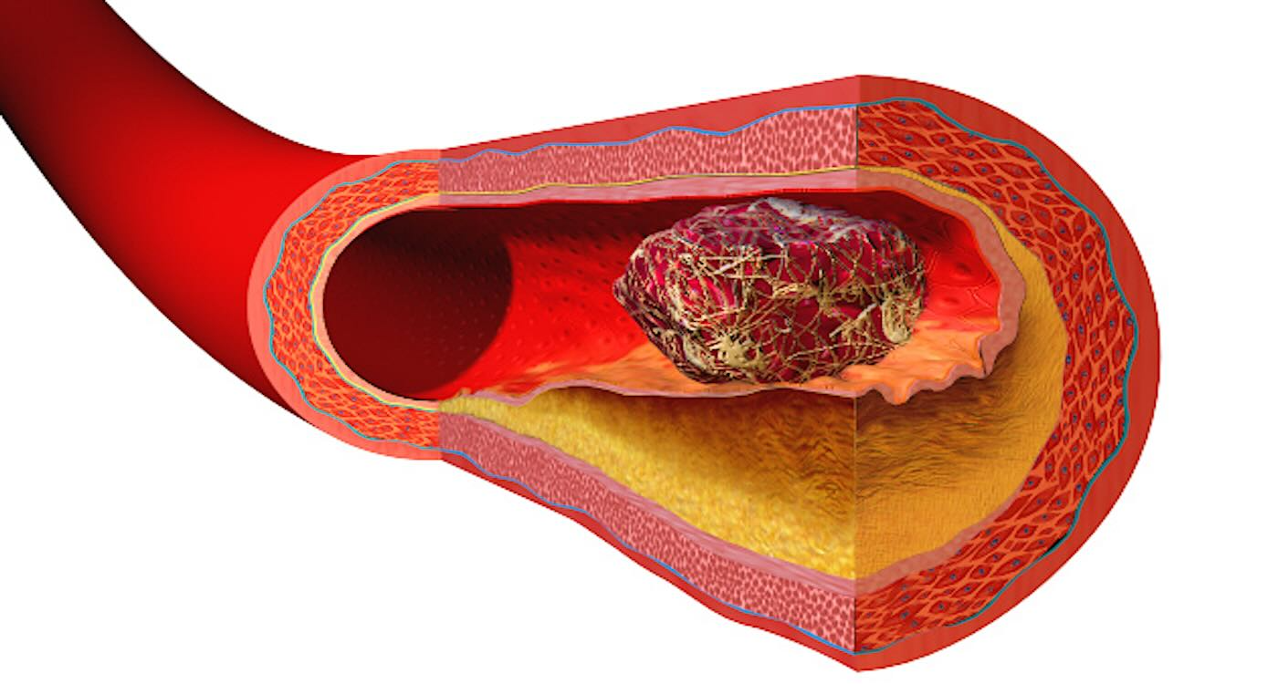 Os cientistas conseguiram identificar a "aglomeração" de plaquetas. - Foto: Bruce Blaus/Blausen Medical