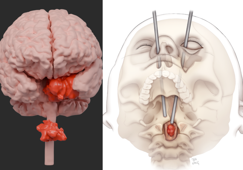 Inicialmente, imaginou-se que era apenas um tumor. Em seguida, os exames mostraram um segundo. Mas tudo deu certo. Foto: CBS News