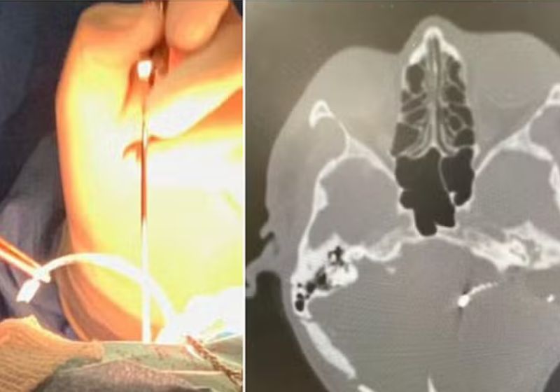 Imagens da cirurgia que implantou o dispositivo para o paciente surdo voltar a escutar. — Foto: Divulgação/CEANNE