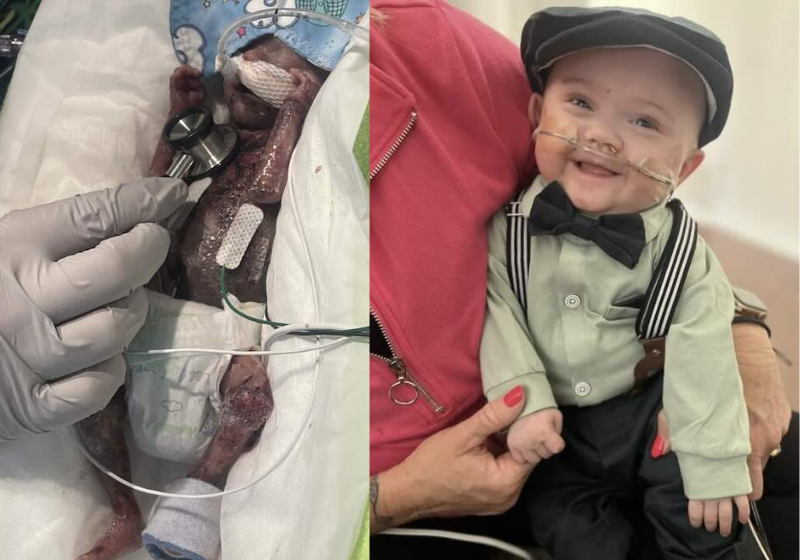 Nash foi considerado o bebê mais prematuro do mundo e até entrou para o Guiness - Foto: arquivo pessoal