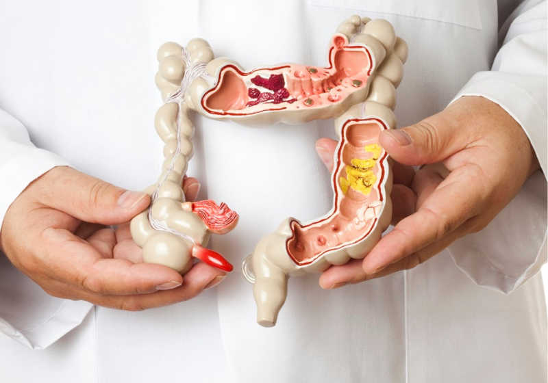 A proteína descoberta, feita nos Estados Unidos, pode ser a esperança para um novo tratamento que ajuda a diminuir o câncer colorretal. - Foto: Pixabay