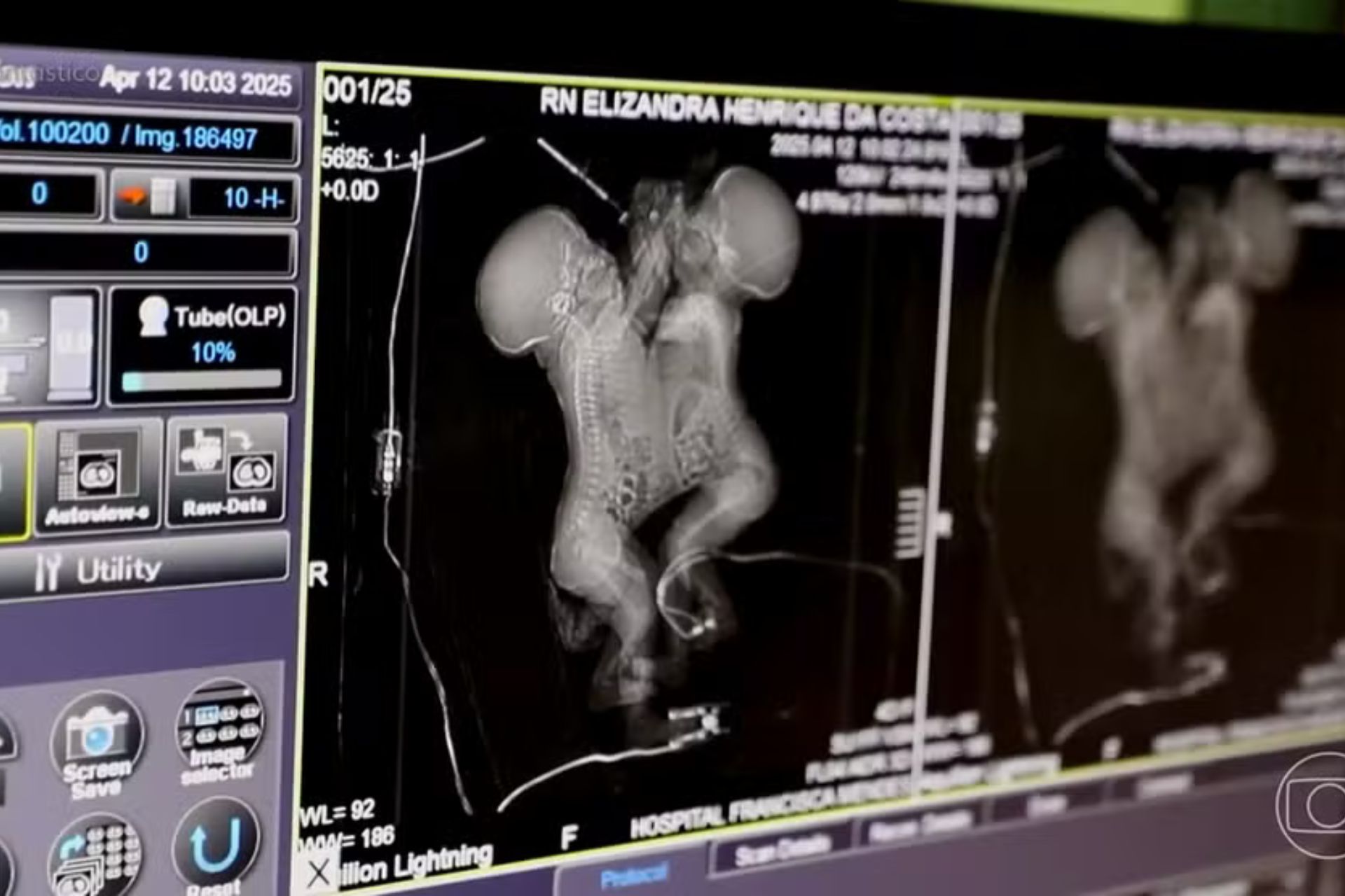 O exame mostrava as gêmeas siamesas unidas pelo tórax, antes da cirurgia de serapação. - Foto: reprodução/Fantástico