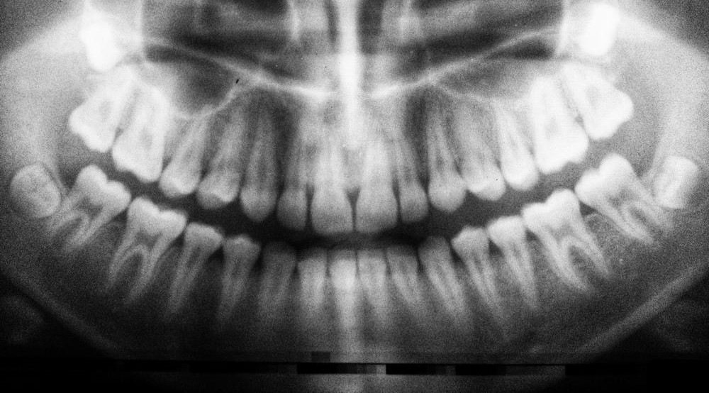 Os dentes do siso contém células-tronco capazes de formar ossos, tecido cardíaco e neurônios. - Foto: Umanoide/Unsplash